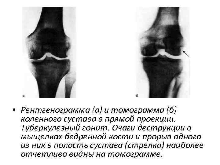  • Рентгенограмма (а) и томограмма (б) коленного сустава в прямой проекции. Туберкулезный гонит.
