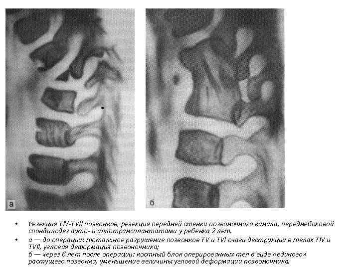  • • Резекция TIV-ТVII позвонков, резекция передней стенки позвоночного канала, переднебоковой спондилодез ауто-