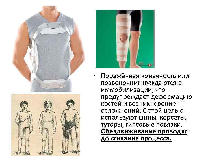  • Поражённая конечность или позвоночник нуждаются в иммобилизации, что предупреждает деформацию костей и