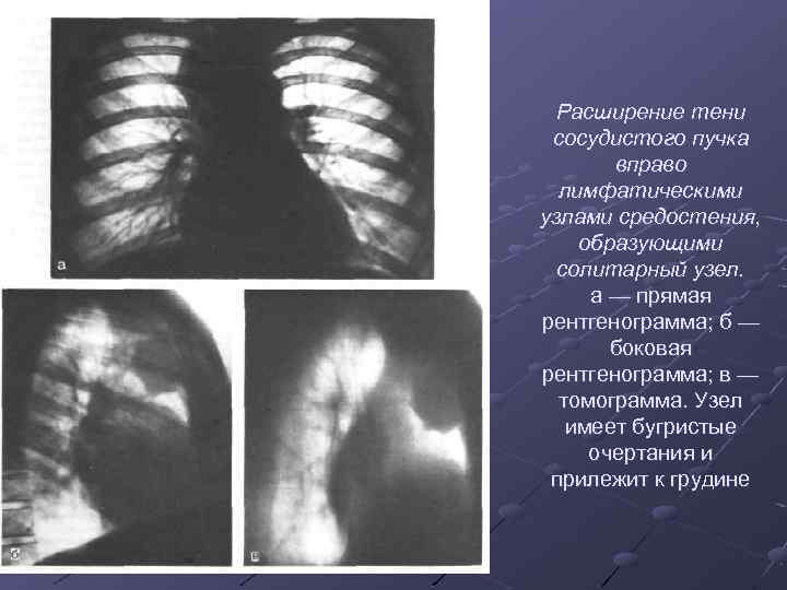Расширение тени сосудистого пучка вправо лимфатическими узлами средостения, образующими солитарный узел. а — прямая