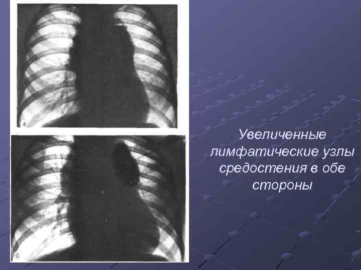 Увеличенные лимфатические узлы средостения в обе стороны 