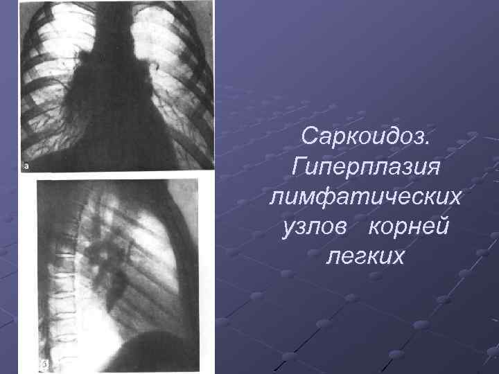 Саркоидоз. Гиперплазия лимфатических узлов корней легких 