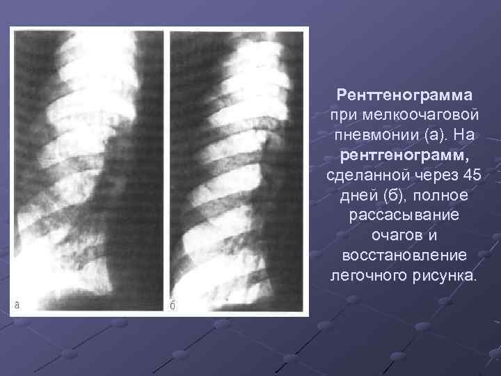 Ренттенограмма при мелкоочаговой пневмонии (а). На рентгенограмм, сделанной через 45 дней (б), полное рассасывание