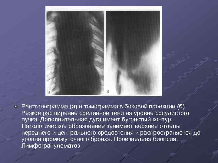 Рентгенограмма (а) и томограмма в боковой проекции (б). Резкое расширение срединной тени на уровне