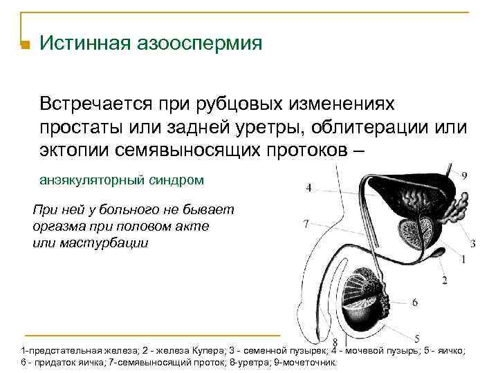 n Истинная азооспермия Встречается при рубцовых изменениях простаты или задней уретры, облитерации или эктопии
