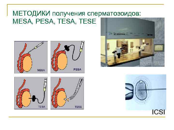 МЕТОДИКИ получения сперматозоидов: MESA, PESA, TESE ICSI 