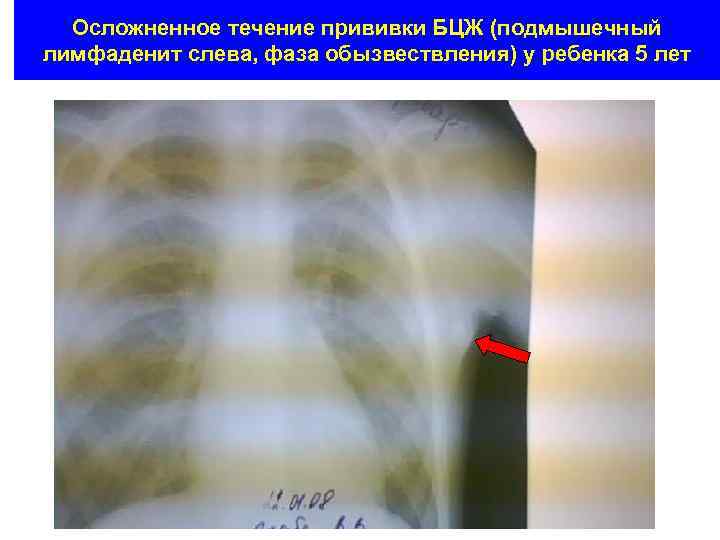 Осложненное течение прививки БЦЖ (подмышечный лимфаденит слева, фаза обызвествления) у ребенка 5 лет 