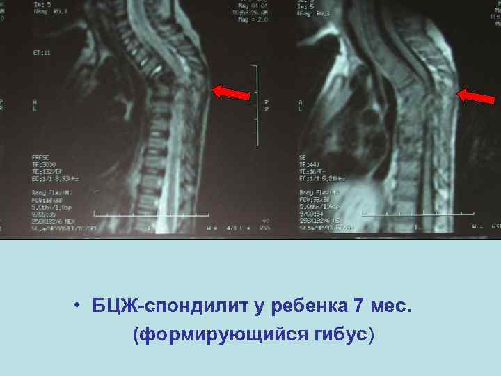  • БЦЖ спондилит у ребенка 7 мес. (формирующийся гибус) 