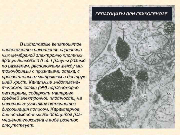 В цитоплазме гепатоцитов определяется накопление ограниченных мембраной электронно плотных гранул гликогена (Гл). Гранулы разные