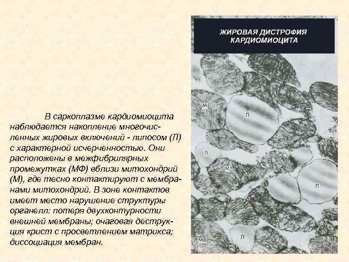 В саркоплазме кардиомиоцита наблюдается накопление многочисленных жировых включений - липосом (Л) с характерной исчерченностью.