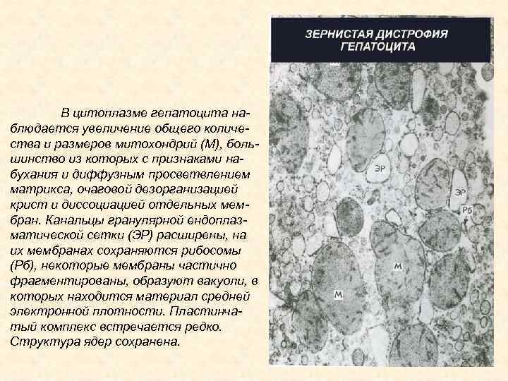 В цитоплазме гепатоцита наблюдается увеличение общего количества и размеров митохондрий (М), большинство из которых