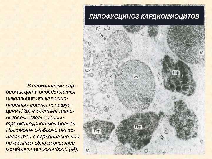 В саркоплазме кардиомиоцита определяется накопления электронноплотных гранул липофусцина (Лф) в составе телолизосом, ограниченных трехконтурной