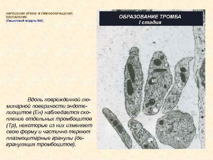 НАРУШЕНИЕ КРОВО- И ЛИМФООБРАЩЕНИЯ. ВОСПАЛЕНИЕ. (Смысловой модуль № 2) № 2 Вдоль поврежденной люминарной