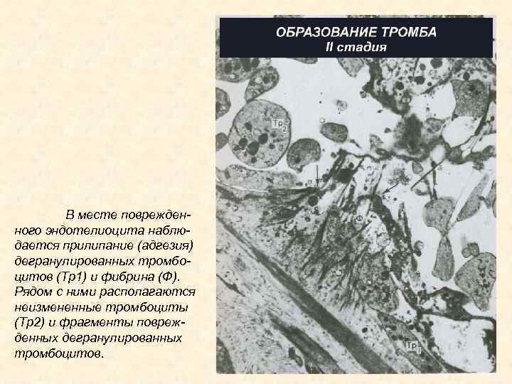 В месте поврежденного эндотелиоцита наблюдается прилипание (адгезия) дегранулированных тромбоцитов (Тр1) и фибрина (Ф). Рядом