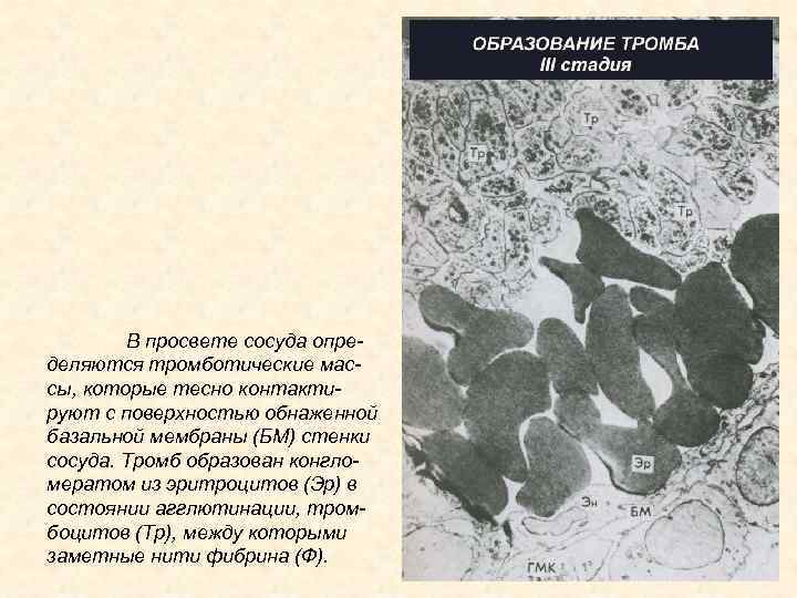 В просвете сосуда определяются тромботические массы, которые тесно контактируют с поверхностью обнаженной базальной мембраны