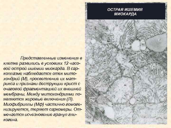 Представленные изменения в клетке развились в условиях 12 часовой острой ишемии миокарда. В саркоплазме