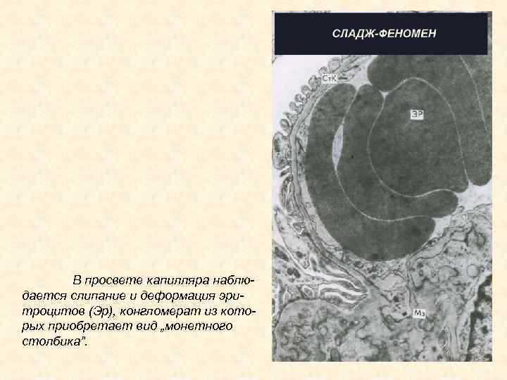 В просвете капилляра наблюдается слипание и деформация эритроцитов (Эр), конгломерат из которых приобретает вид