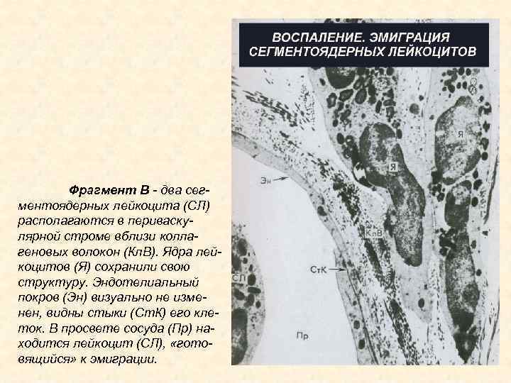 Фрагмент В - два сегментоядерных лейкоцита (СЛ) располагаются в периваскулярной строме вблизи коллагеновых волокон