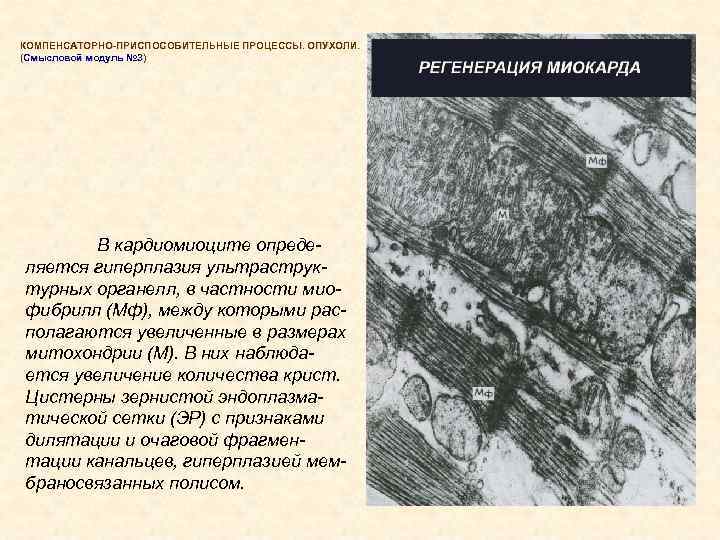 КОМПЕНСАТОРНО-ПРИСПОСОБИТЕЛЬНЫЕ ПРОЦЕССЫ. ОПУХОЛИ. (Смысловой модуль № 3) В кардиомиоците определяется гиперплазия ультраструктурных органелл, в