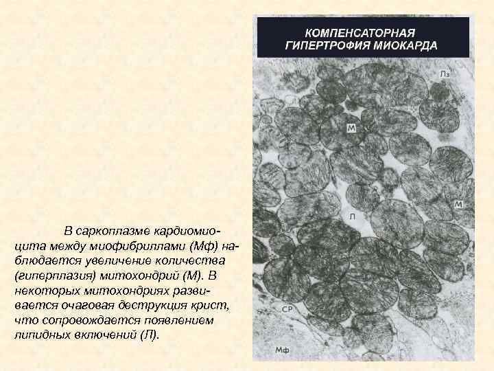 В саркоплазме кардиомиоцита между миофибриллами (Мф) наблюдается увеличение количества (гиперплазия) митохондрий (М). В некоторых