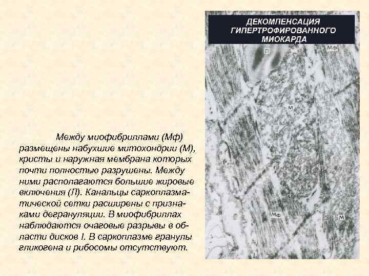 Между миофибриллами (Мф) размещены набухшие митохондрии (М), кристы и наружная мембрана которых почти полностью