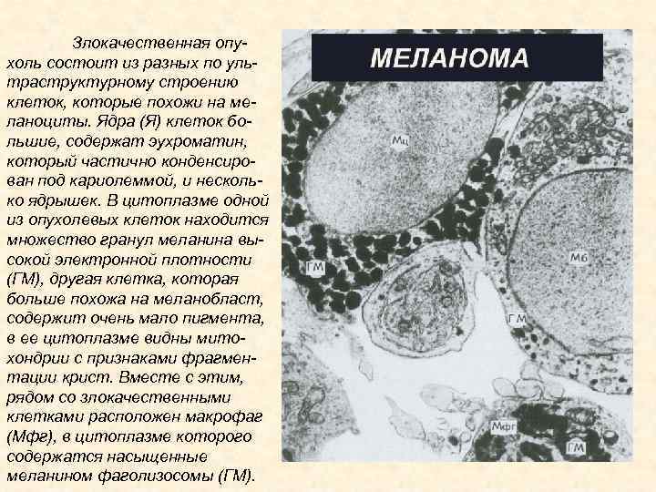 Злокачественная опухоль состоит из разных по ультраструктурному строению клеток, которые похожи на меланоциты. Ядра