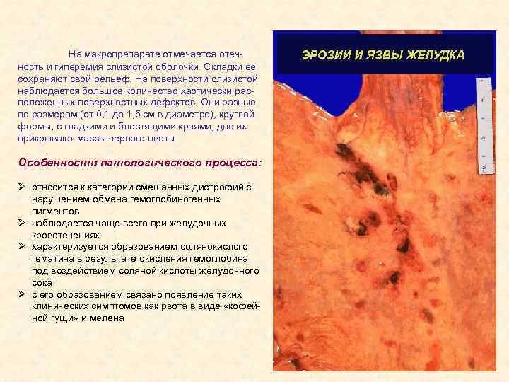 На макропрепарате отмечается отечность и гиперемия слизистой оболочки. Складки ее сохраняют свой рельеф. На