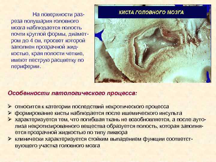 На поверхности разреза полушария головного мозга наблюдается полость почти круглой формы, диаметром до 4