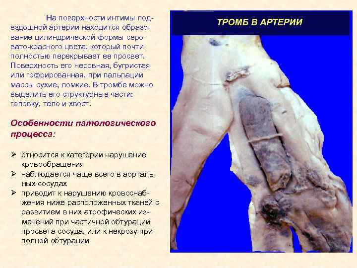На поверхности интимы подвздошной артерии находится образование цилиндрической формы серовато-красного цвета, который почти полностью