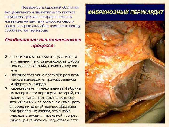 Поверхность серозной оболочки висцерального и париетального листков перикарда тусклая, пестрая и покрыта нитевидными массами
