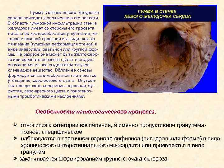 Гумма в стенке левого желудочка сердца приводит к расширению его полости. В области гуммозной