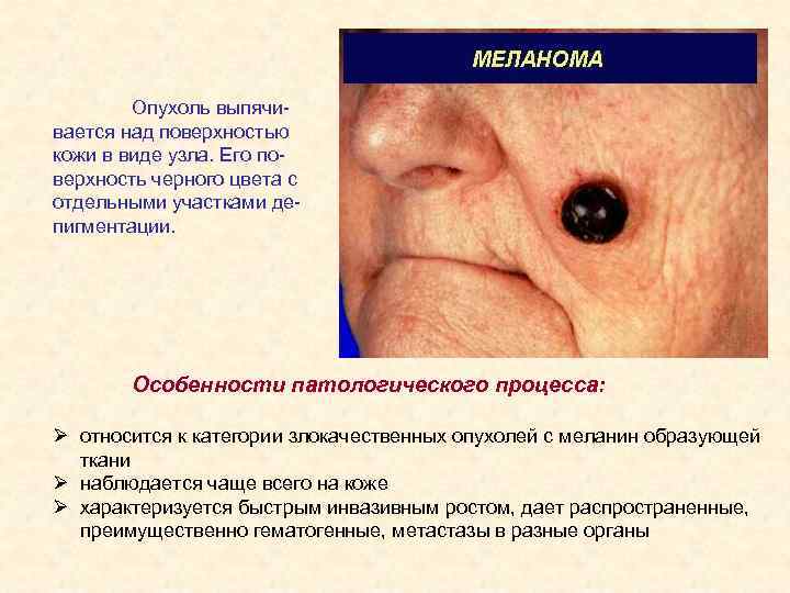 Опухоль выпячивается над поверхностью кожи в виде узла. Его поверхность черного цвета с отдельными