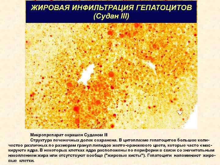 Процесс сопровождающийся накоплением в цитоплазме гепатоцитов