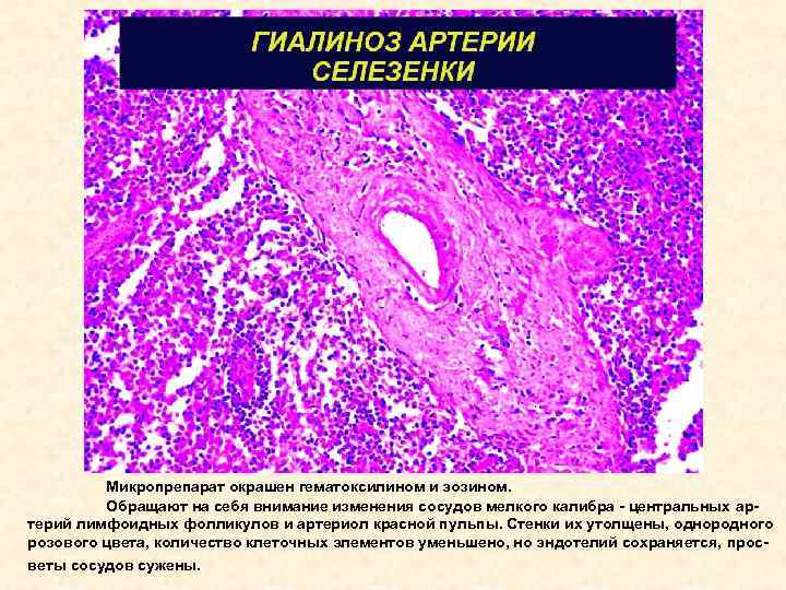 Микропрепарат окрашен гематоксилином и эозином. Обращают на себя внимание изменения сосудов мелкого калибра -