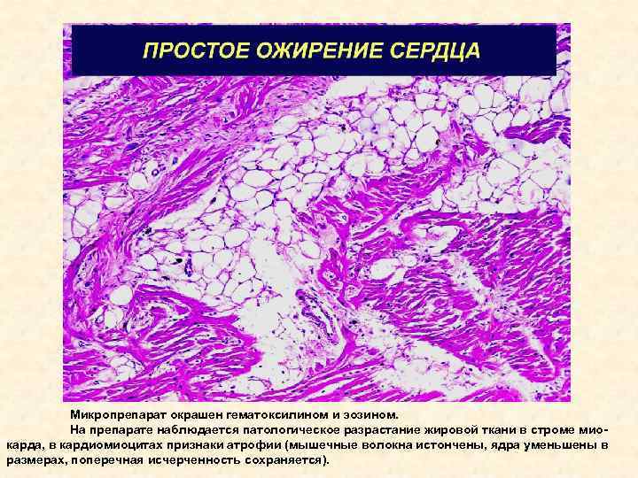 Жировая дистрофия миокарда. Ожирение сердца микропрепарат. Ожирение сердца патологическая анатомия макропрепарат. Жировая инфильтрация миокарда микропрепарат. Ожирение сердца патанатомия макропрепарат.