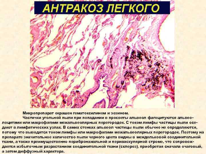 Силикоз легкого микропрепарат рисунок