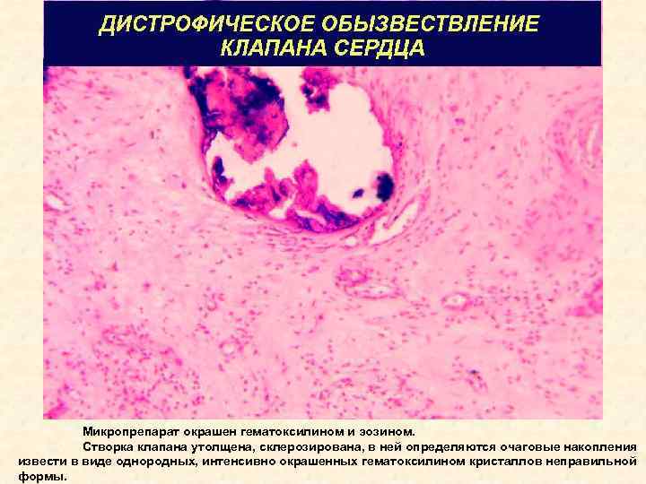 Обызвествление это. Петрификация клапана сердца микропрепарат. Дистрофическое обызвествление. Дистрофическое обызвествление микропрепарат. Дистрофическое обызвествление артерий матки.