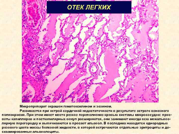 Венозное полнокровие развивается при. Отек легкого микропрепарат патанатомия. Отек легких микропрепарат патанатомия. Отёк легких патологическая анатомия. Отек легких микропрепарат.