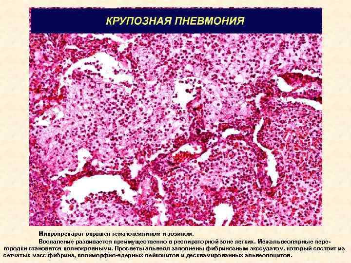 Очаговая пневмония рисунок микропрепарат