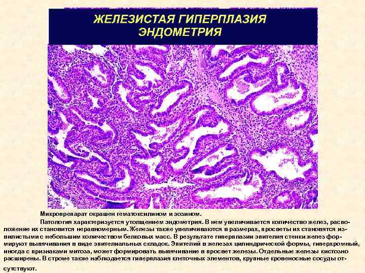 Железистая гиперплазия эндометрия после. Гиперплазия эндометрия микропрепарат. Железисто-кистозная гиперплазия эндометрия микропрепарат. Железистая гиперплазия эндометрия гистология. Железистая гиперплазия слизистой оболочки матки микропрепарат.