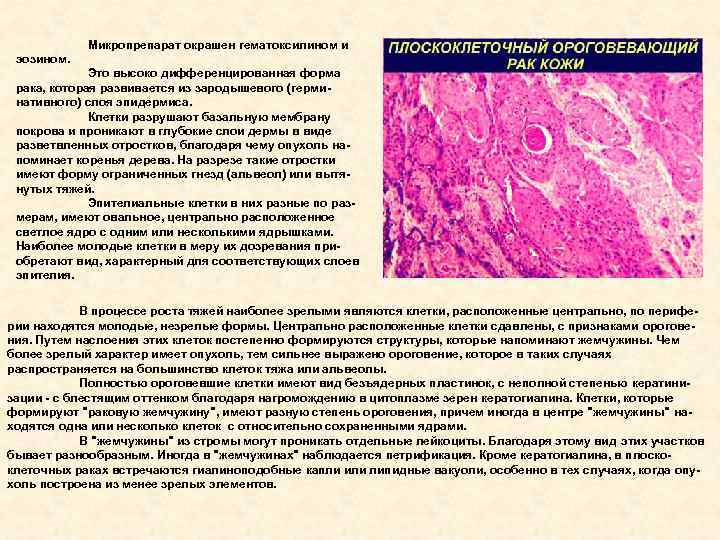Микропрепарат окрашен гематоксилином и эозином. Это высоко дифференцированная форма рака, которая развивается из зародышевого