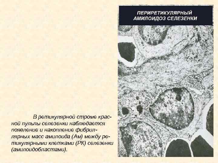 В ретикулярной строме красной пульпы селезенки наблюдается появление и накопление фибриллярных масс амилоида (Ам)