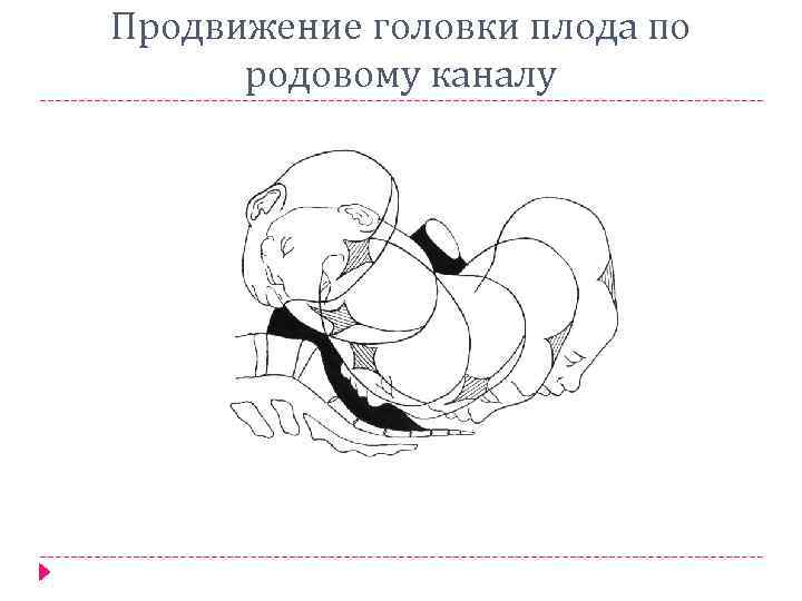 Продвижение головки плода по родовому каналу 