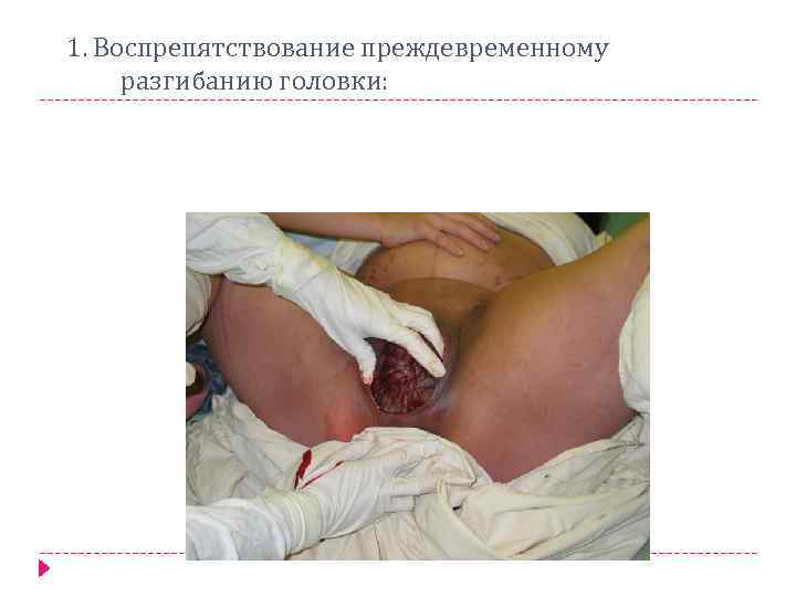  1. Воспрепятствование преждевременному разгибанию головки: 