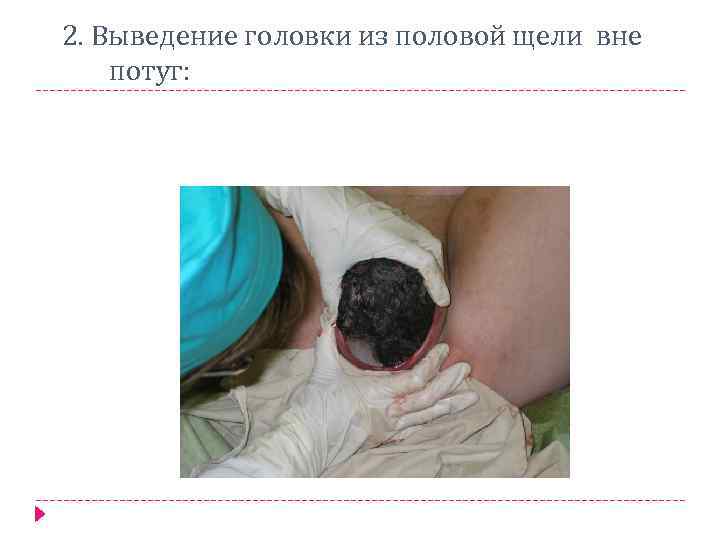  2. Выведение головки из половой щели вне потуг: 