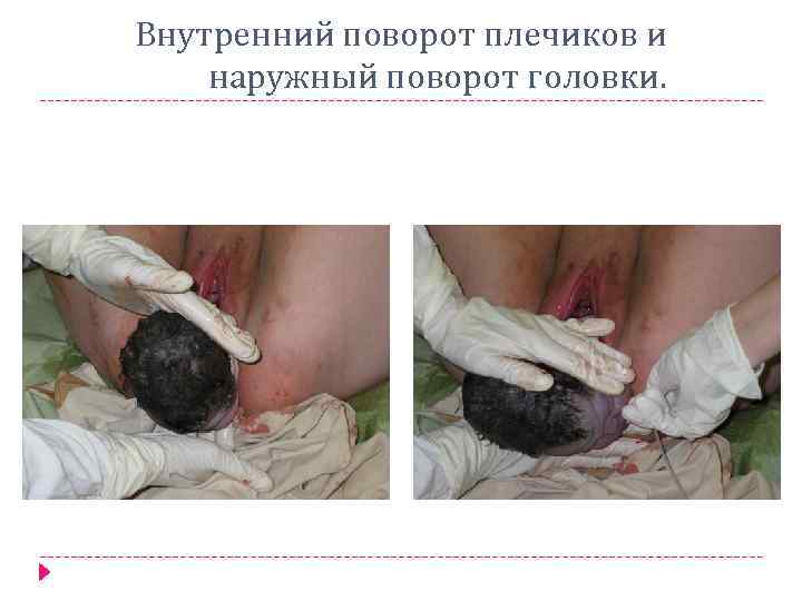 Внутренний поворот плечиков и наружный поворот головки. 