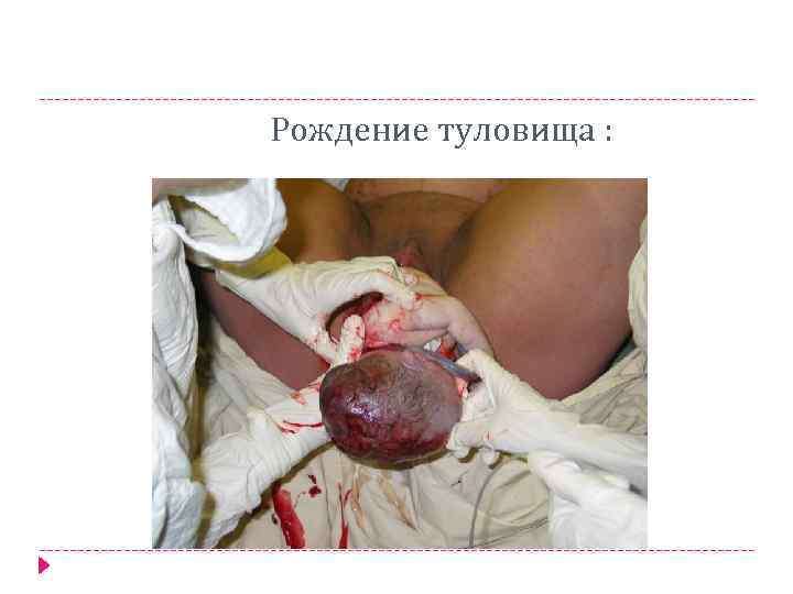  Рождение туловища : 