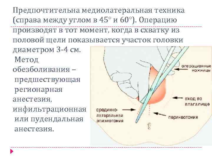 Предпочтительна медиолатеральная техника (справа между углом в 45° и 60°). Операцию производят в тот