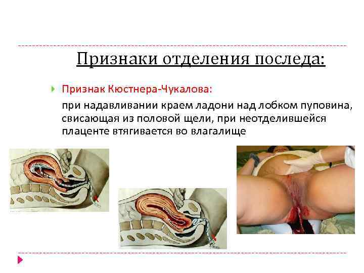 Признаки отделения последа: Признак Кюстнера-Чукалова: при надавливании краем ладони над лобком пуповина, свисающая из