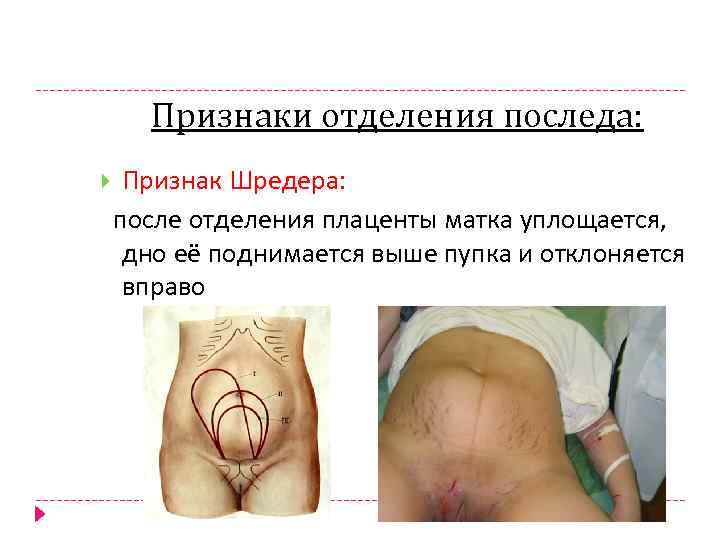 Признаки отделения последа: Признак Шредера: после отделения плаценты матка уплощается, дно её поднимается выше